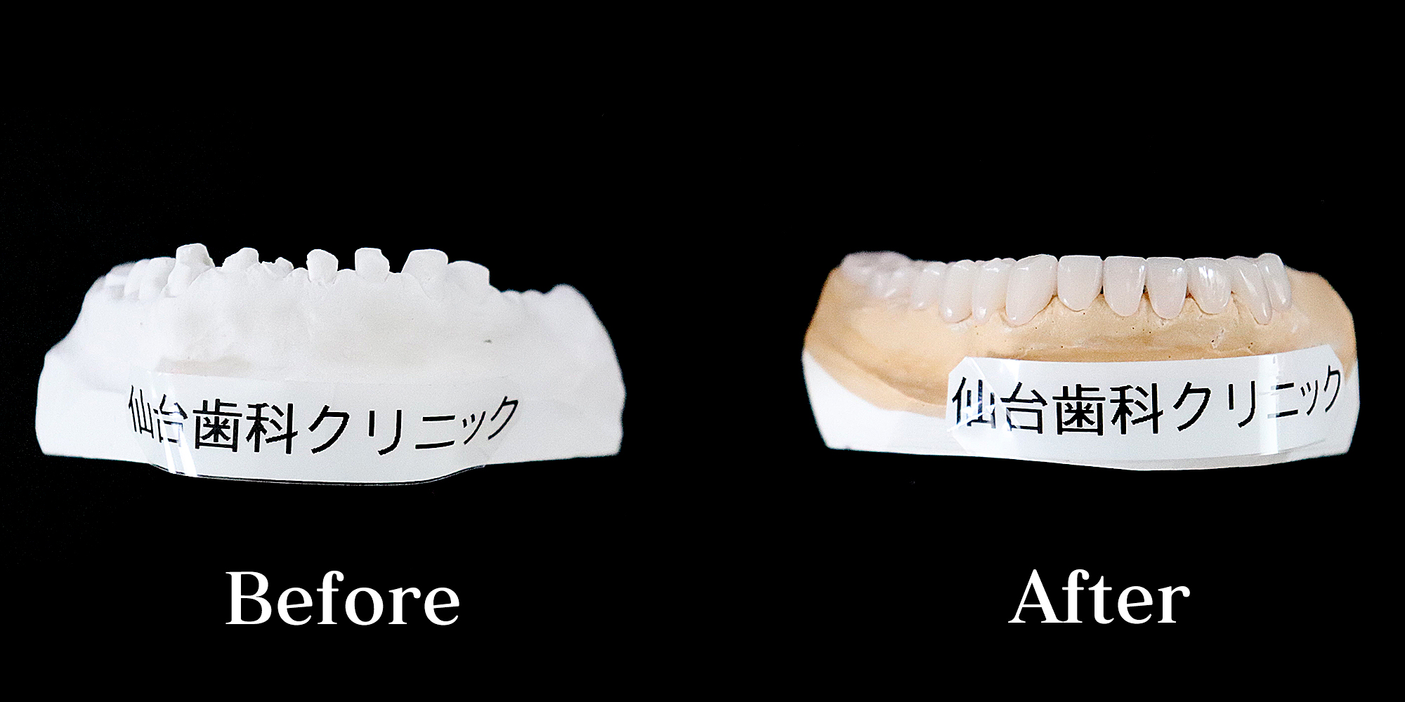 エナメル質形成不全症