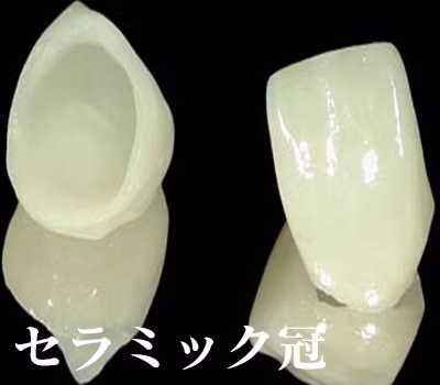 セラミック冠
