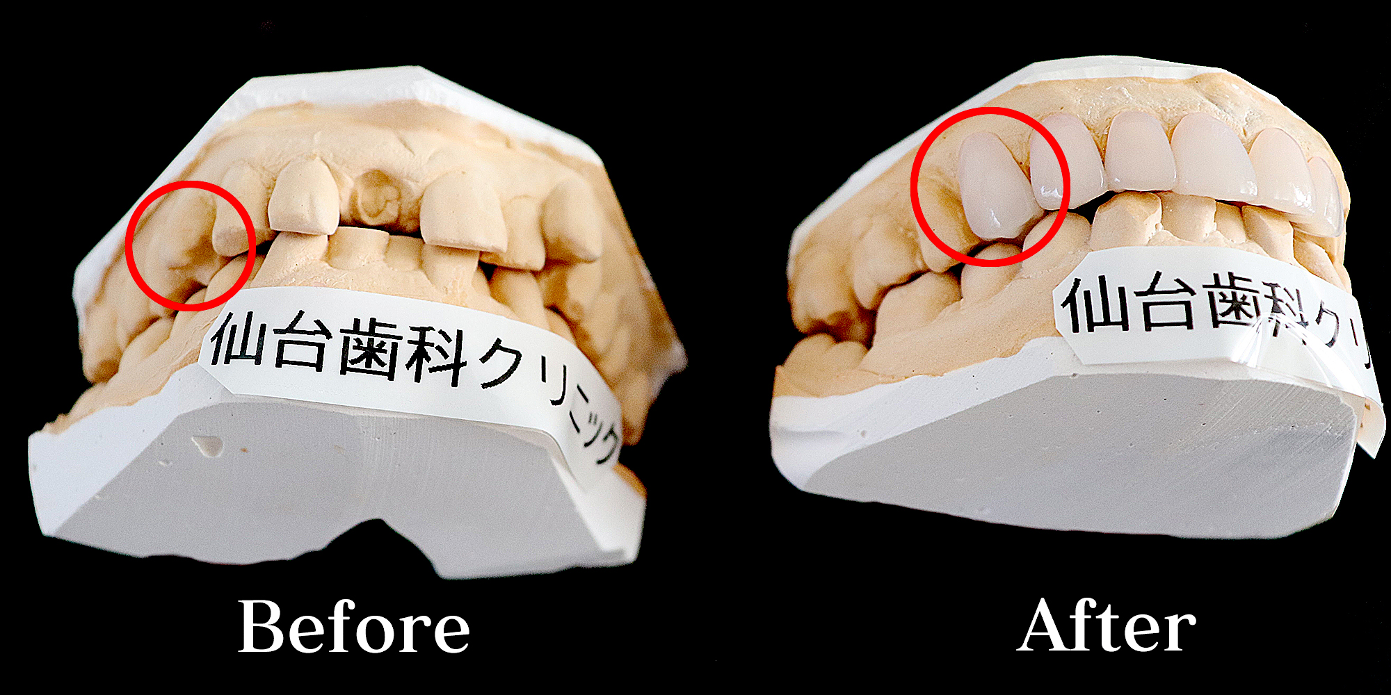 ビフォーアフター鋏上咬合