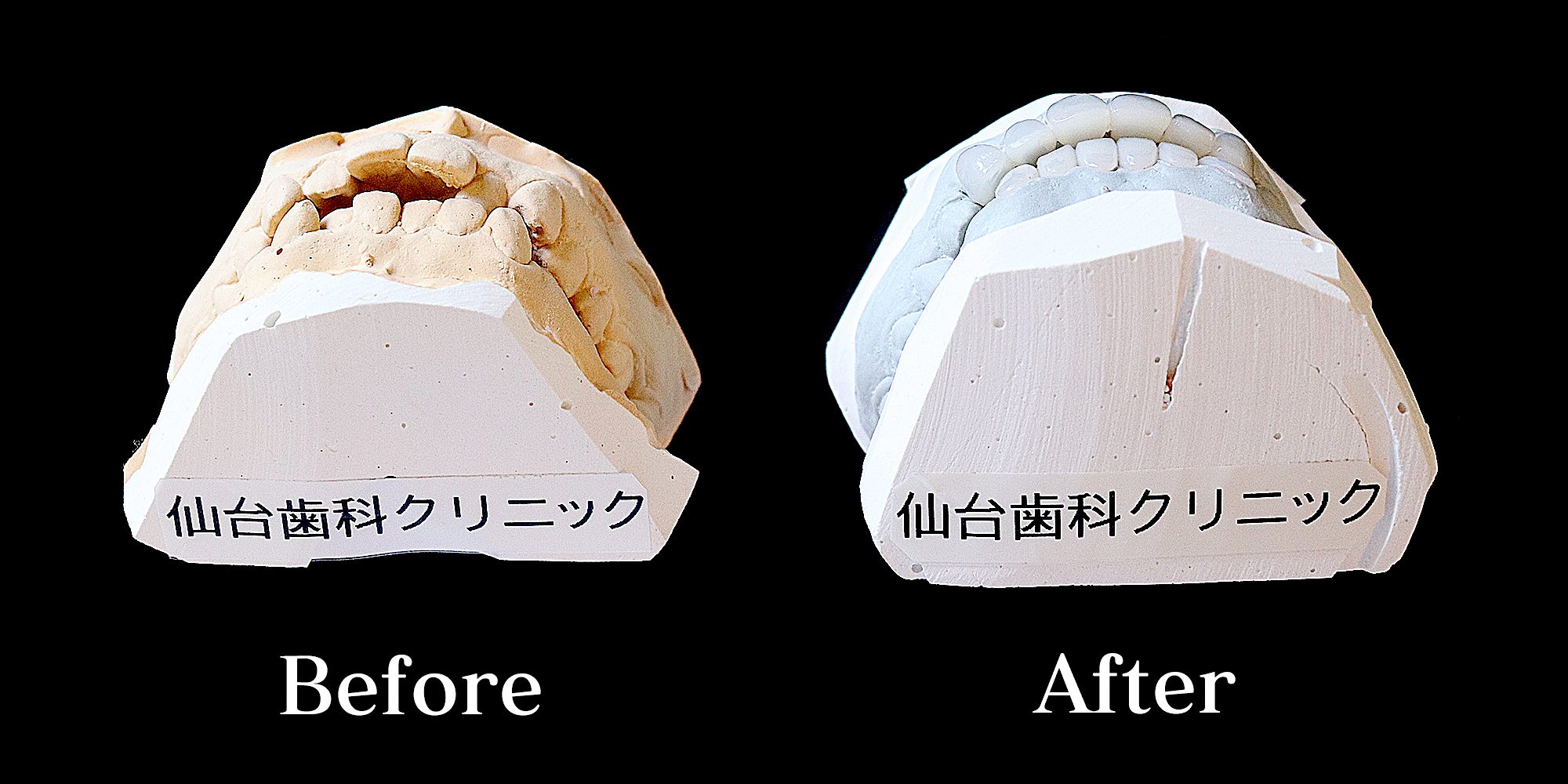 ビフォーアフター開口上下の前歯の隙間