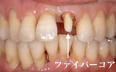 ファイバーコア