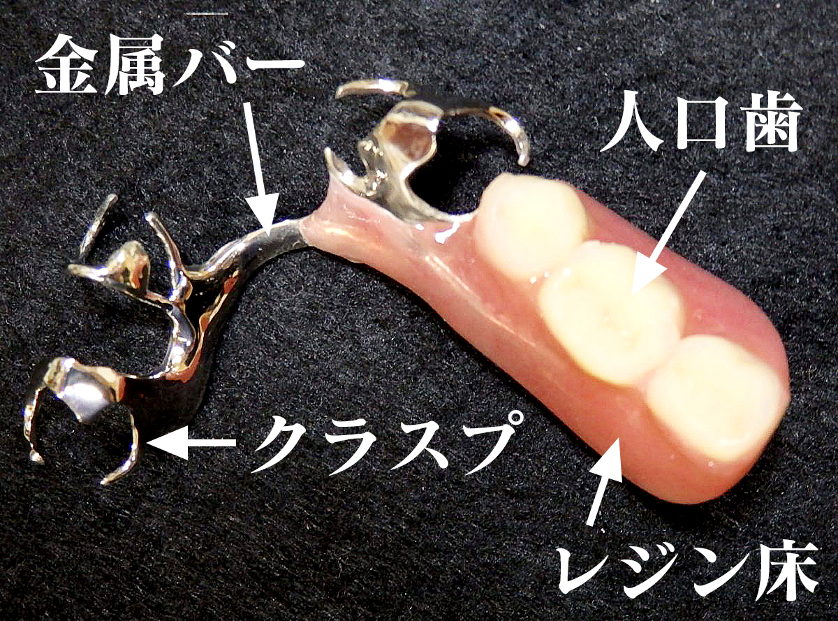 部分床義歯